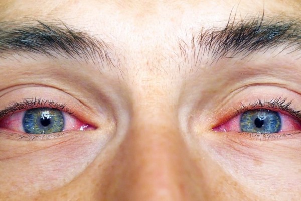 conjuntivitis1.jpg