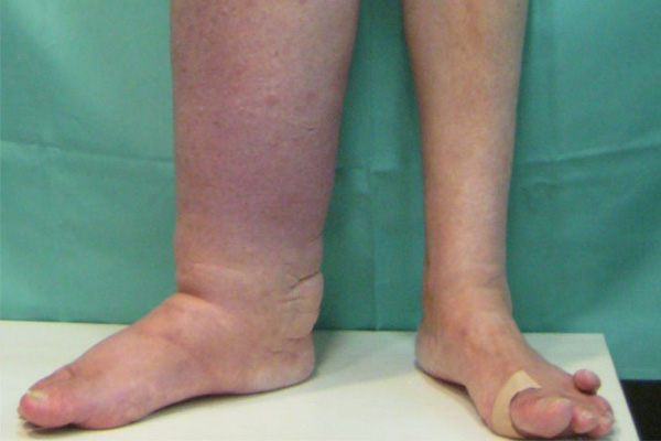 linfedema2.jpg