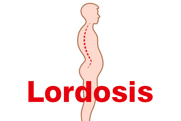 Lordosis - Clinica Medica Porter