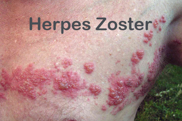 Herpes-Zoster2.jpg