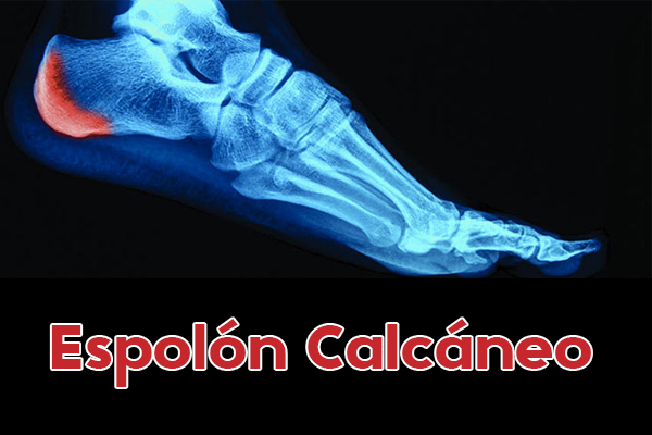 espolon_calcaneo2.jpg