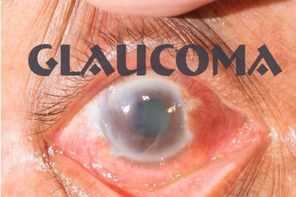 glaucoma2.jpg