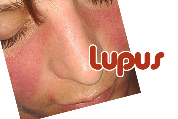 lupus2.jpg