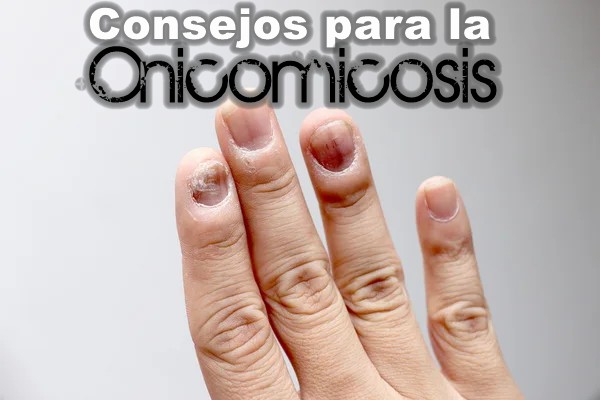 2consejos-onicomicosis.jpg