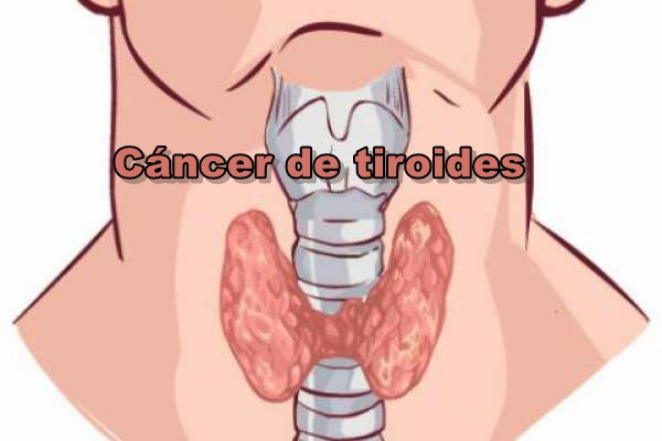 3cancer-de-tiroides.jpg