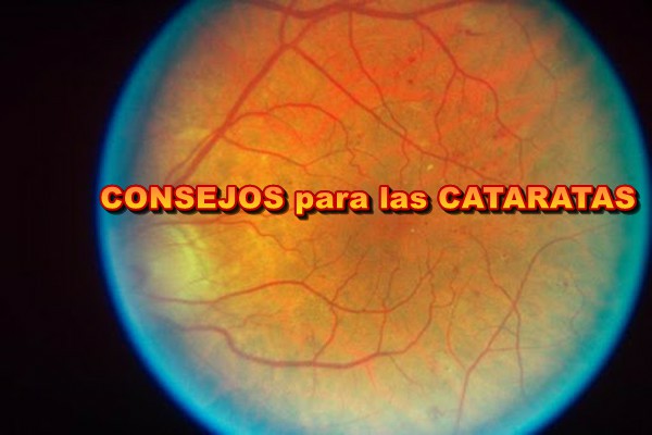 2consejos-cataratas.jpg