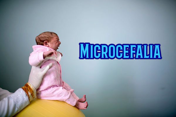 1microcefalia.jpg