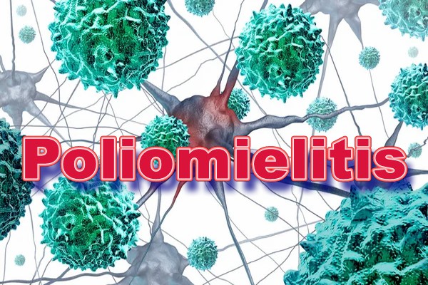 1poliomielitis.jpg