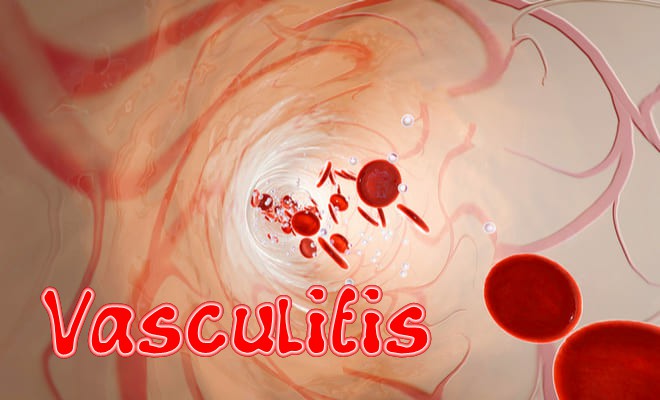 1vasculitis.jpg