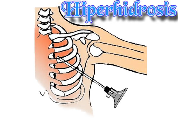 2hiperhidrosis.png