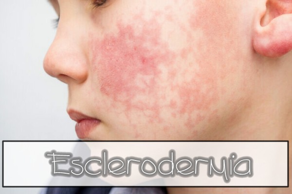 1esclerodermia.jpg