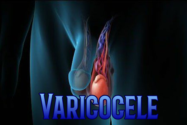 varicocele2.jpg