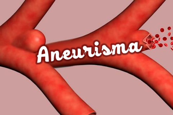 1aneurisma.jpg