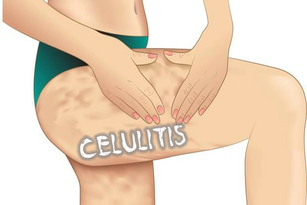 celulitis2.webp