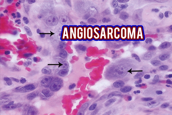 angiosarcoma-2.jpg
