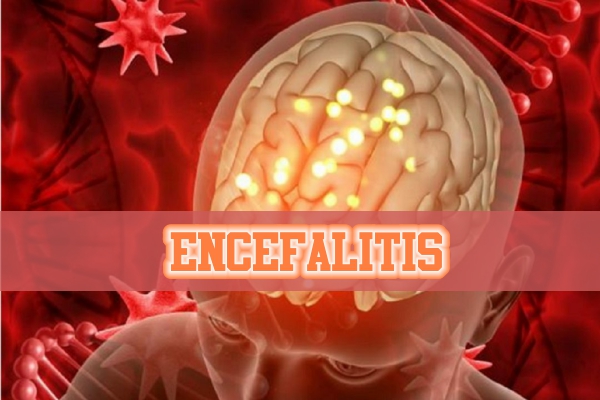 encefalitis-2.jpg