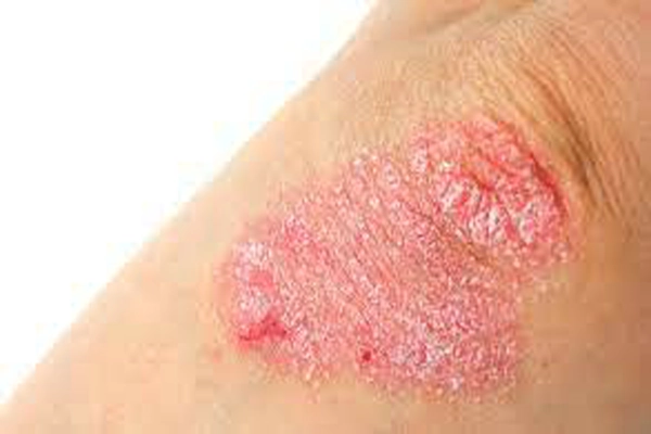 psoriasis-3.webp