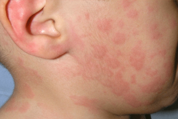 urticaria-3.jpg
