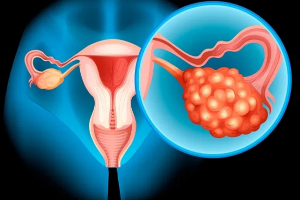 cancer-de-ovario-3.jpg