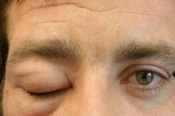 angioedema.jpg