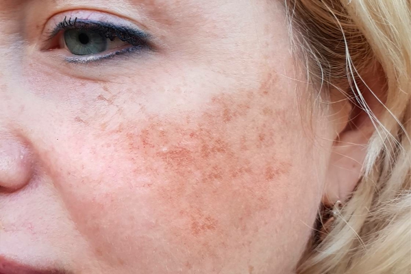 Melasma.jpg